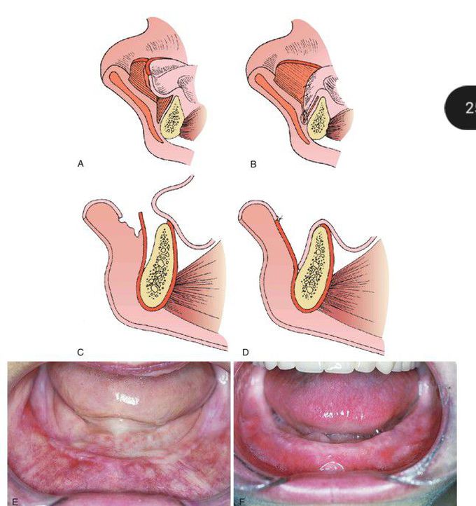 Lip switch procedure