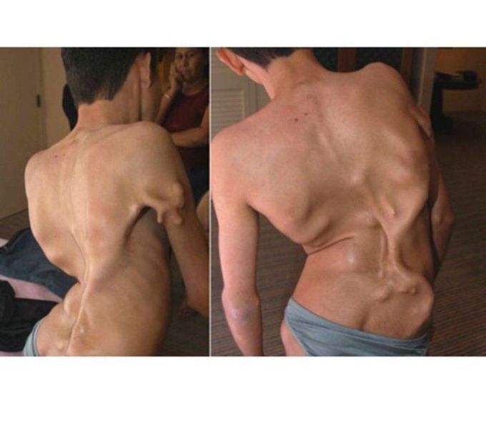 Fibrodysplasia Ossificans Progressiva (FOP)