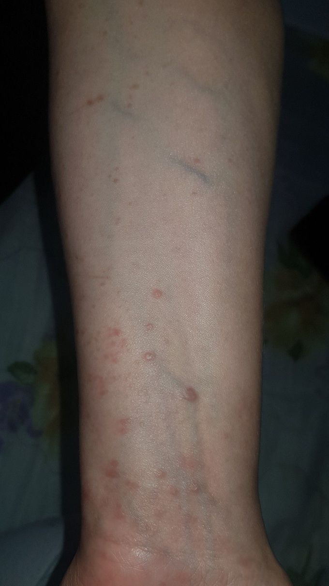 New treatment for lichen planus?