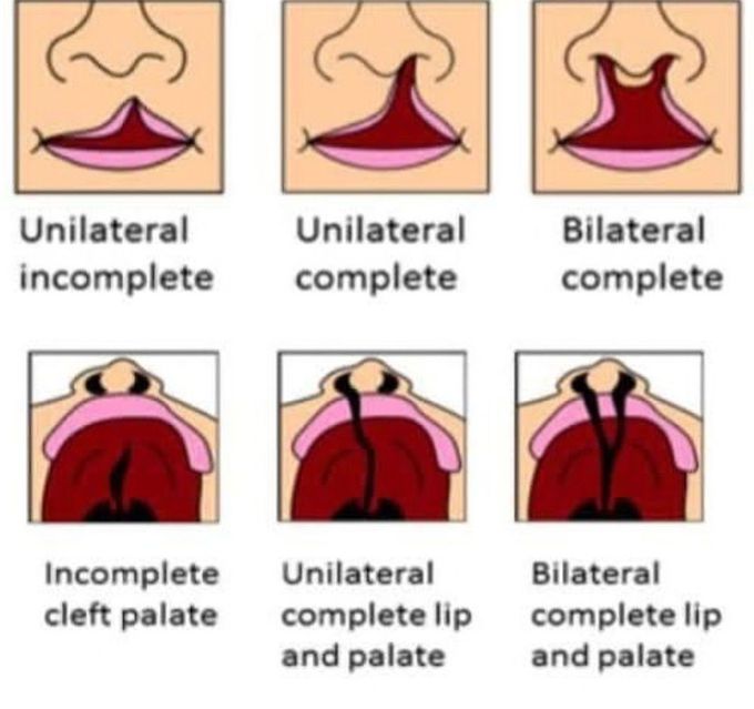 Cleft Lip and Palate