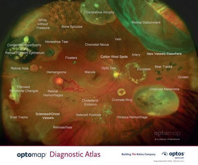 Eye fundus