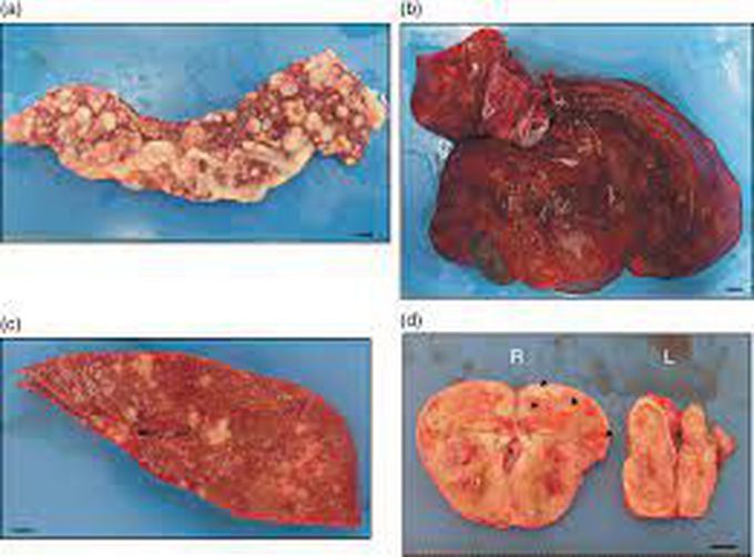 6 Ds of Glucagonoma - a Mnemonic