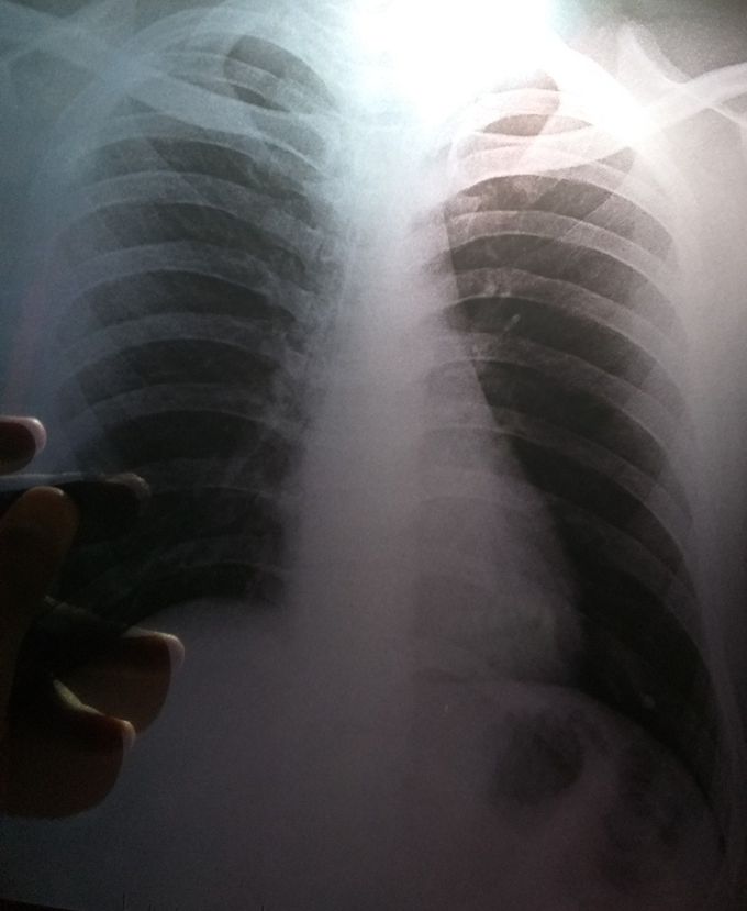 Left lower lobe consolidation....H/o - patient complaining bad odor sputum and mucus without cough from 1 year.... plz diagnose