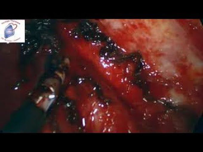 Left Uniportal VATS Completion Pneumonectomy for Bronchiectasis
