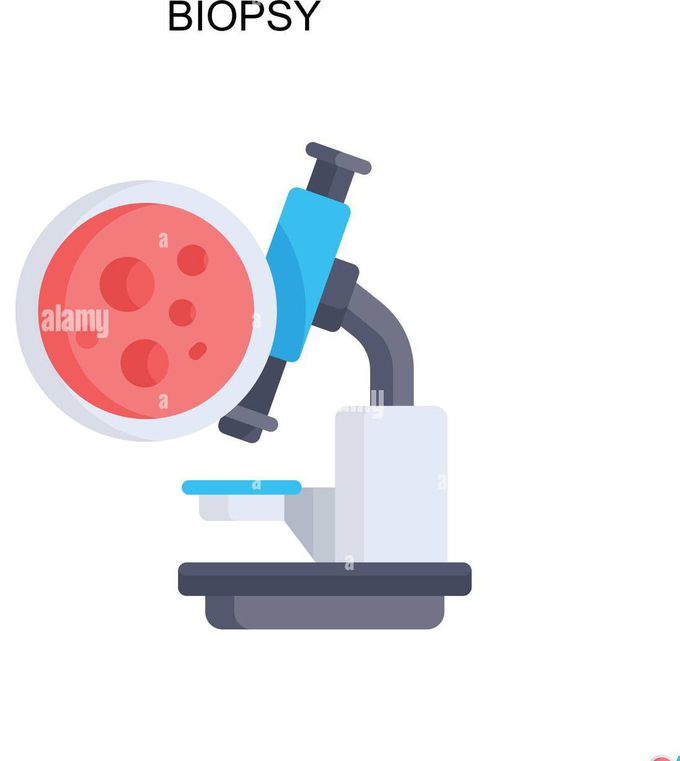 Biopsy