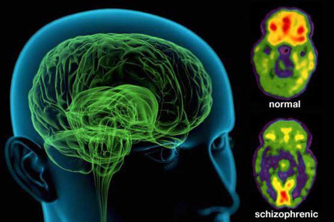 Schizophrenia