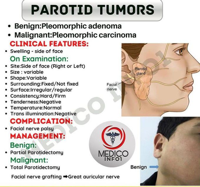 Parotid tumors