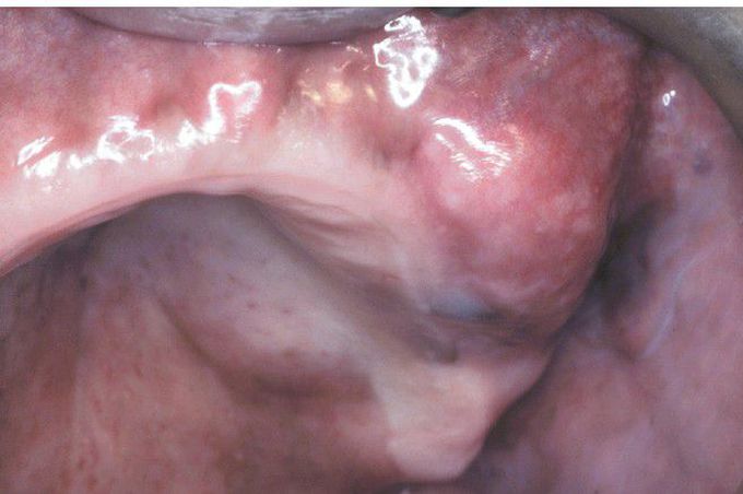 Adenoid Cystic Carcinoma