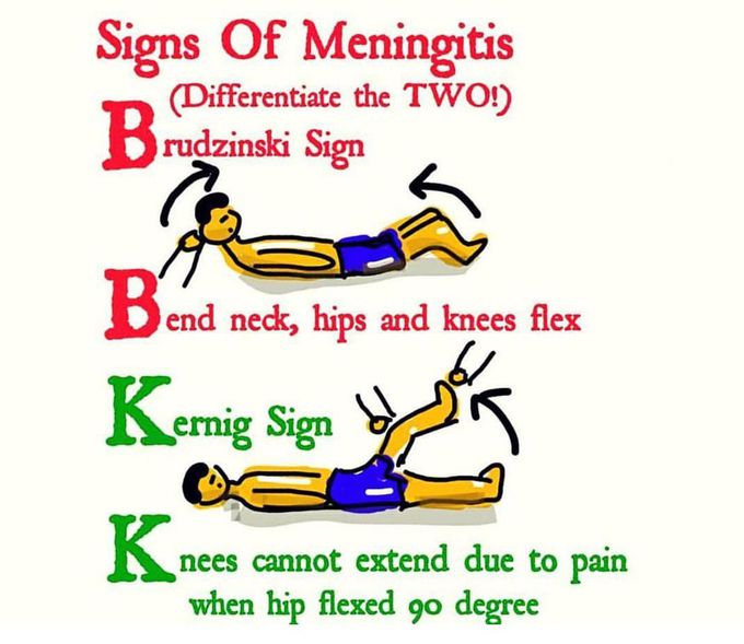 Signs_ of _meningitis ___