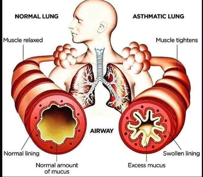 Normal lung vs Asthmatic lung