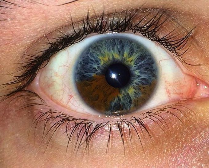 Sectoral heterochromia :)