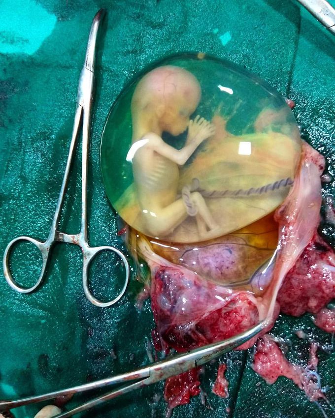 Spontaneously miscarried