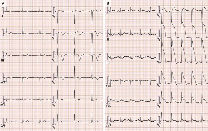 Wellens’ Syndrome