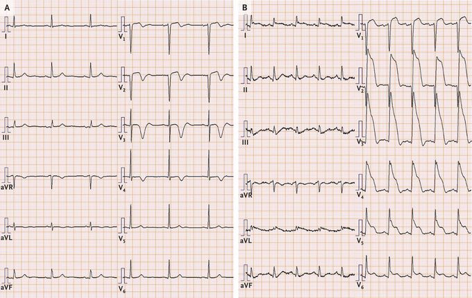 Wellens’ Syndrome