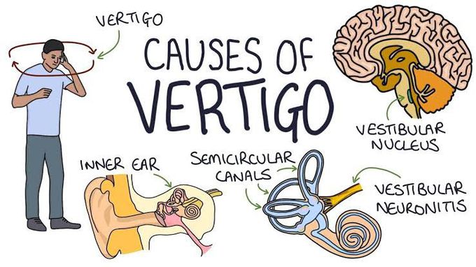Causes of vertigo