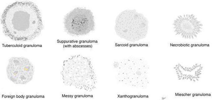 Types of Granuloma