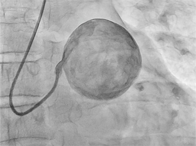 Left Main Coronary Artery Aneurysm