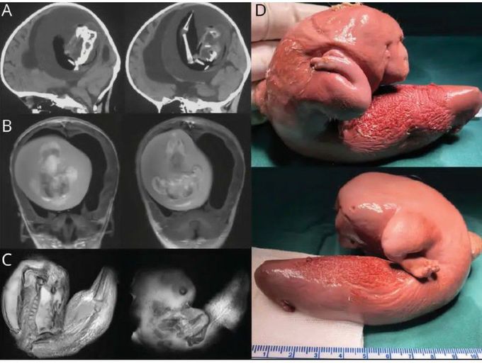 Fetus Removed From the Brain of a 1-year-old Girl