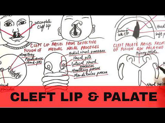 Cleft Lip and Palate Overview