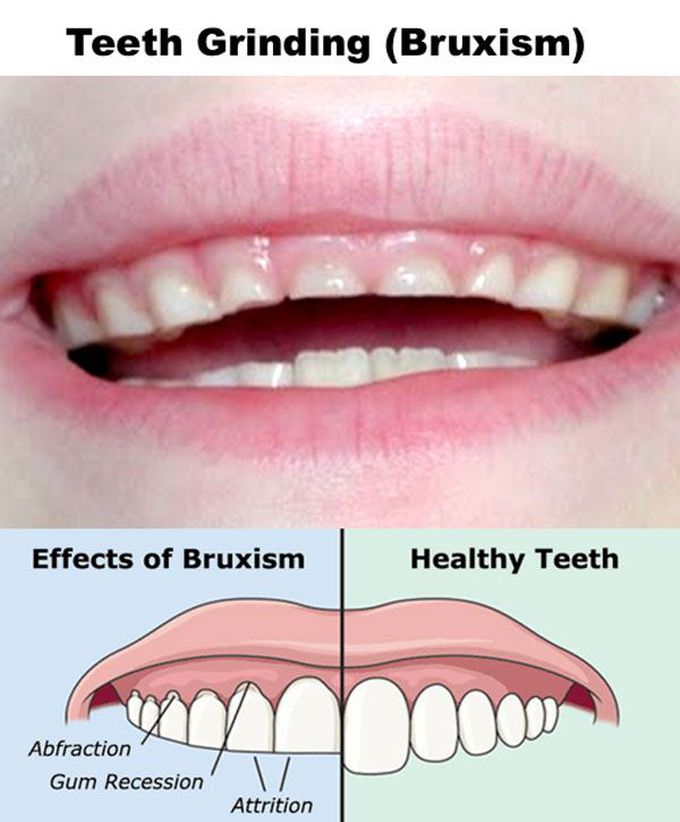 Why is teeth grinding harmful?