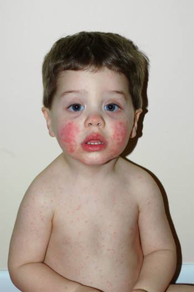 Erythema infectiosum