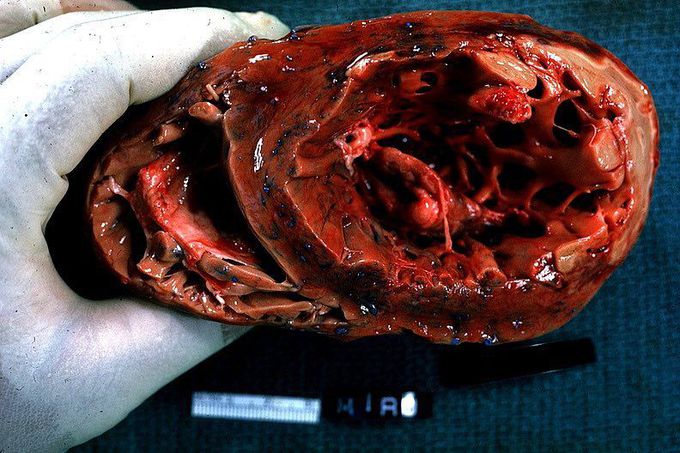 Papillary muscle infarct with rupture!! 