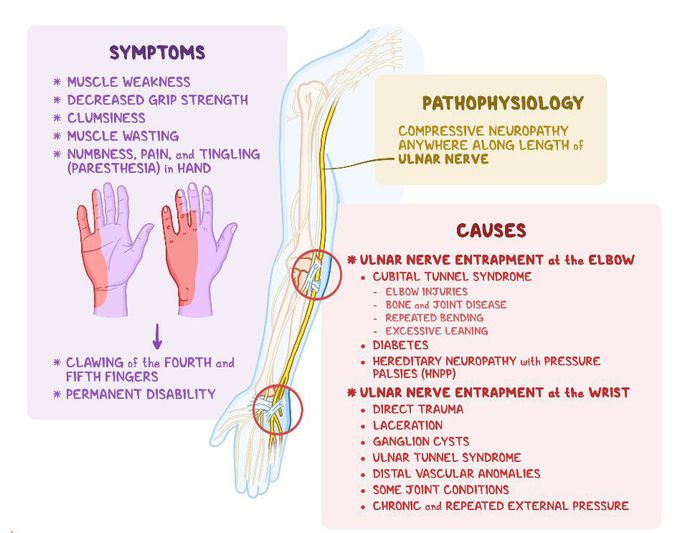 Symptoms of  Cubital tunnel syndrome