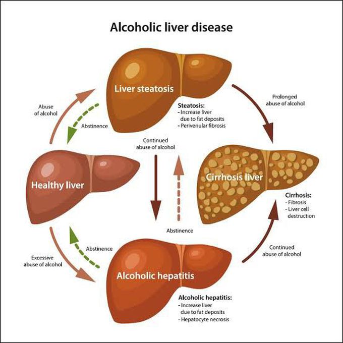Alcoholic Liver Disease