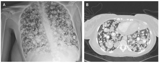 Pulmonary Metastases from Chondroblastic Osteosarcoma