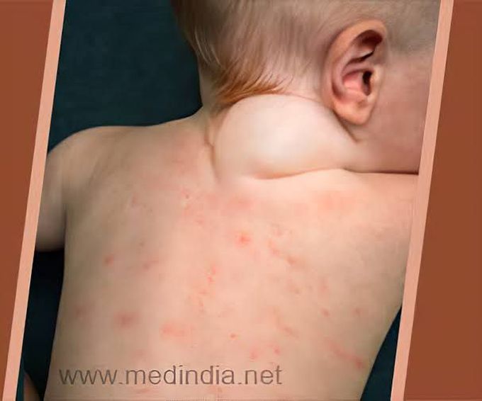 Management of hygroma