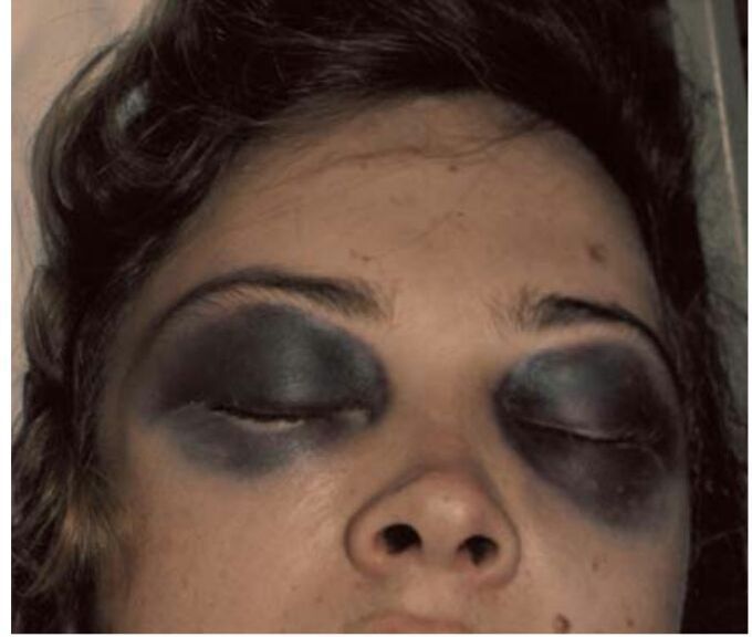 Bilateral black eyes
