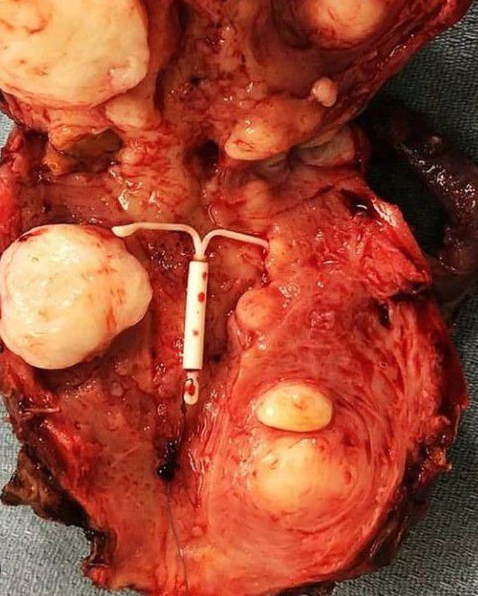 Uterine myomas