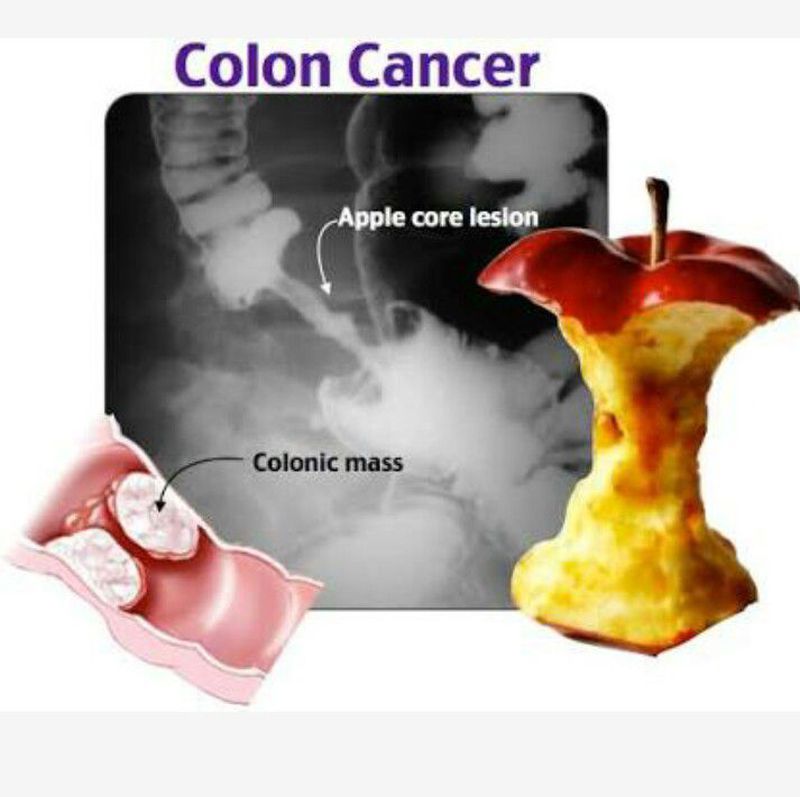 Colon Cancer Apple Core Lesion Medizzy 