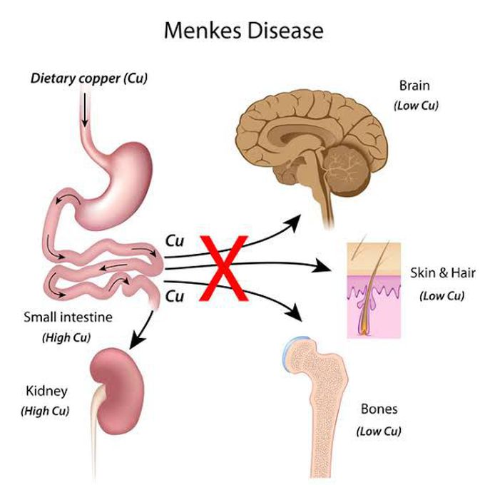 Menkes disease causes
