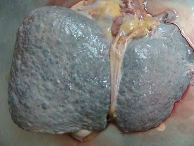 Cirhosis of the liver