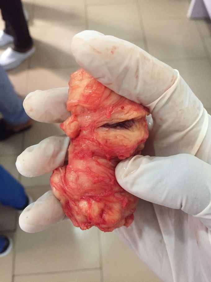 Myomectomy