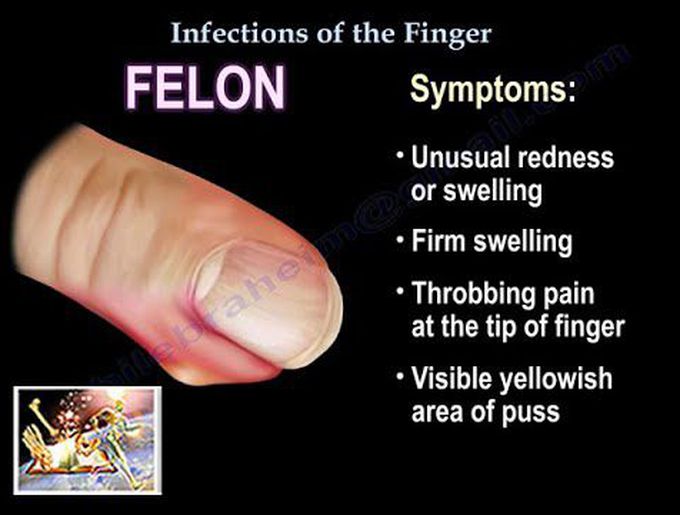 Infections Of The Finger - Everything You Need To Know - Dr. Nabil Ebraheim