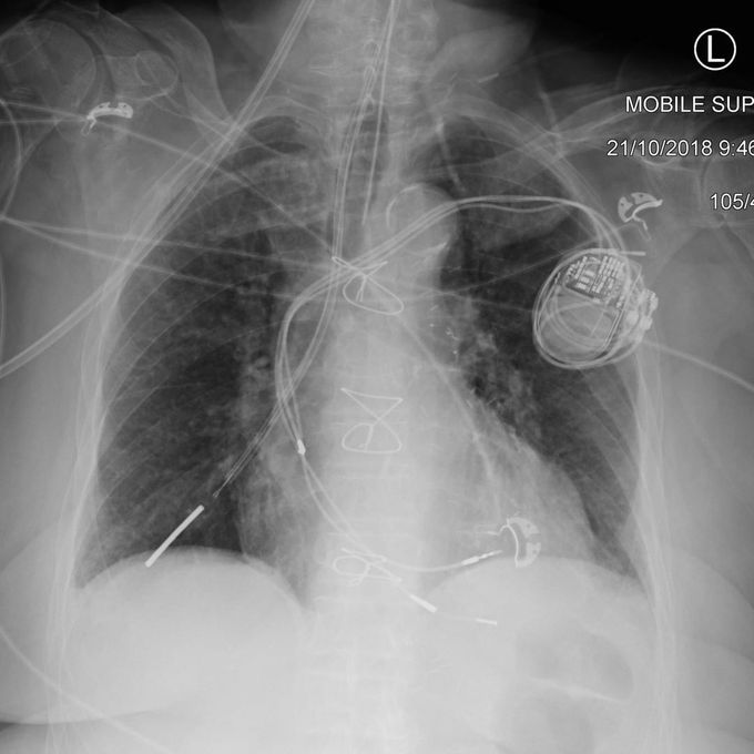 Misplaced Nasogastric Tube