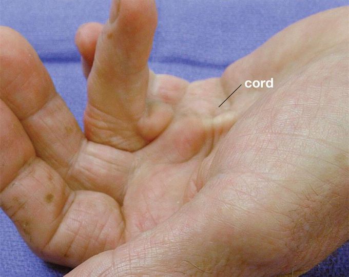 Dupuytren’s contracture is an abnormal thickening of the tissue just beneath the skin. This thickening occurs in the palm and can extend into the fingers. Firm pits, bumps and cords (thick lines) can develop and cause the fingers to bend into the palm. This condition may also be known as Dupuytren’s Disease. Occasionally, the disease will cause thickening on top of the knuckles or cause lumps and cords on the soles of the feet (plantar fibromatosis).

@medcase