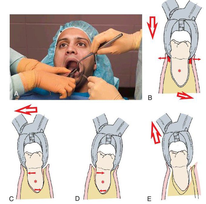 Mandibular molars extraction