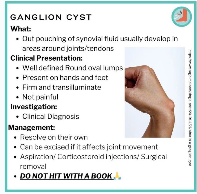 Ganglion Cyst