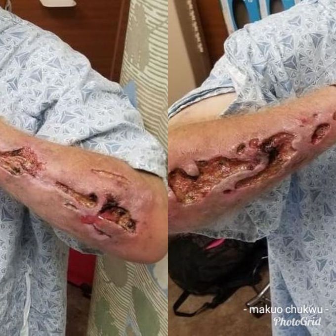 Severe Infections and skin Necrosis