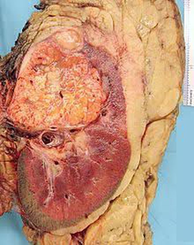 Grawitz tumor