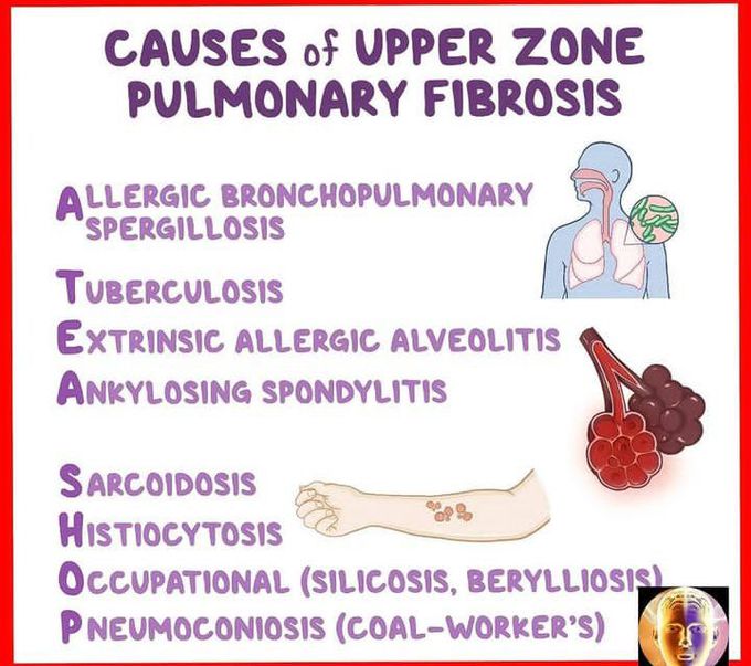 Causes of upper zone pulmonary fibrosis