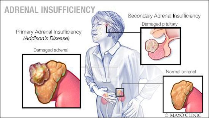 Mayo Clinic Q and A: Understanding adrenal insufficiency