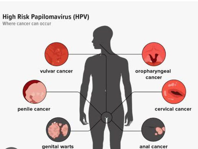 Where HPV (Human Papillomavirus) Cancer can occur ?