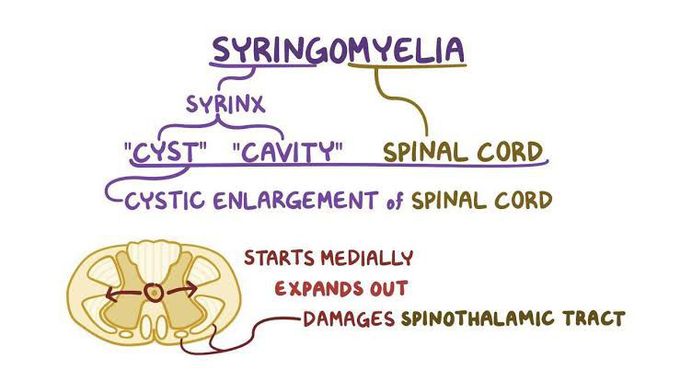 Syringomyelia