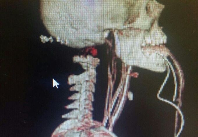 Internal decapitation