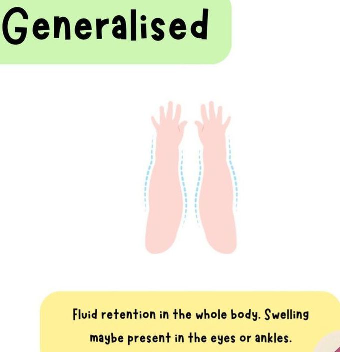 Generalized Edema