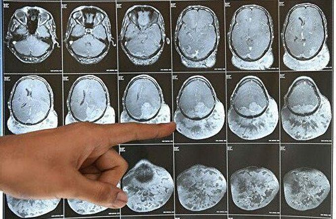 1.8Kg Brain Tumor